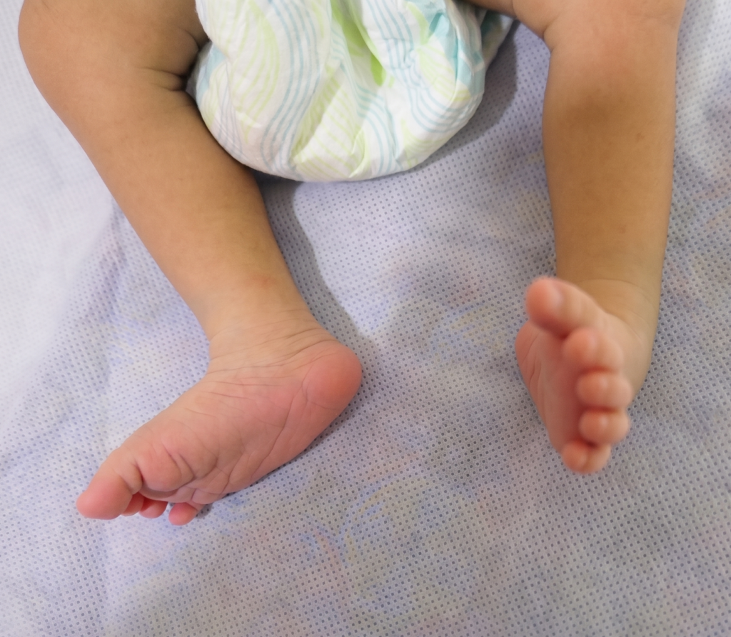 clubfoot 3