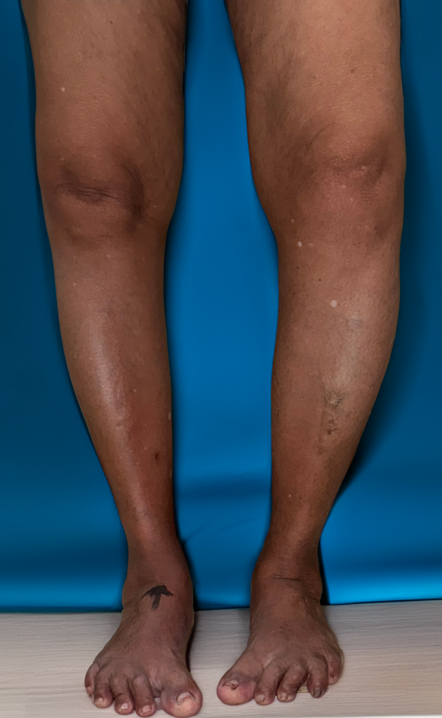 oa knee clinical