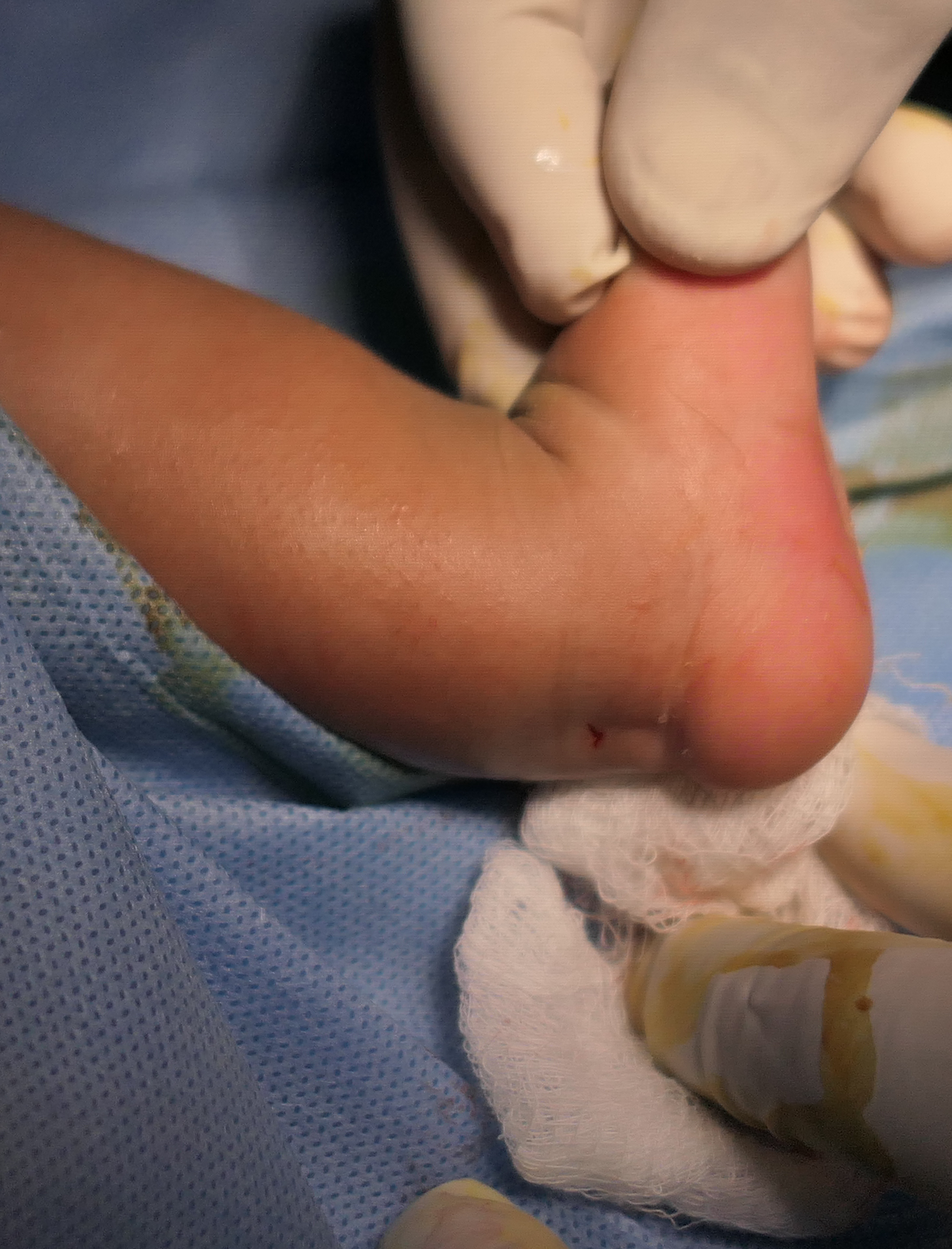 tenotomy