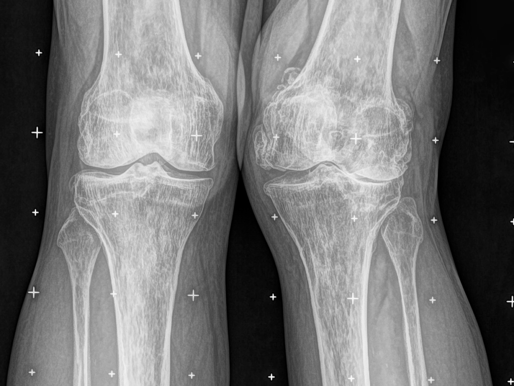 valgus knee