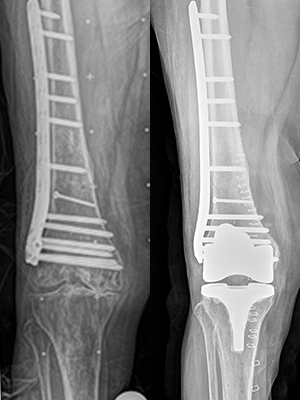 fracture femur robo